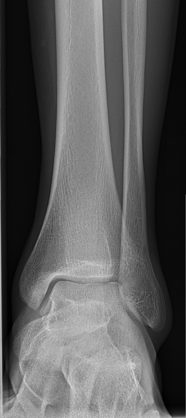 Röntgenbild eines menschlichen Beins mit einer Fraktur am Knöchel, das die Knochen und Bänder des Knöchels zeigt.